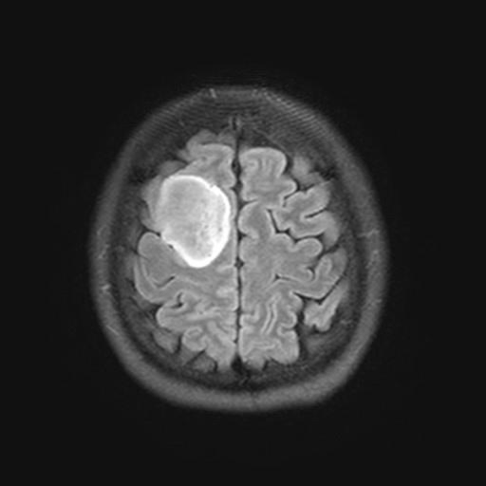Photo of Dimas Martinez's brain tumor.